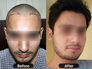4 months hair transplant results