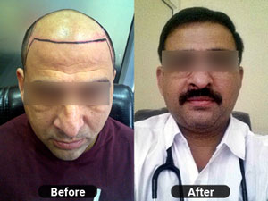 Full Hair Transplant by Hair Max - Ludhiana