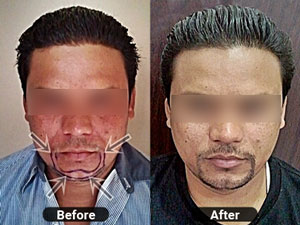 Beard Transplantation by Hair Max - Ludhiana