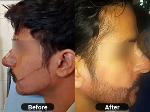 Beard Transplantation by Hair Max - Ludhiana