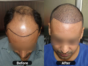 Front and Head Transplantation